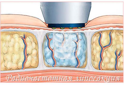 Радиочастотная липосакция