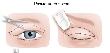 блефаропластики: разметка разреза