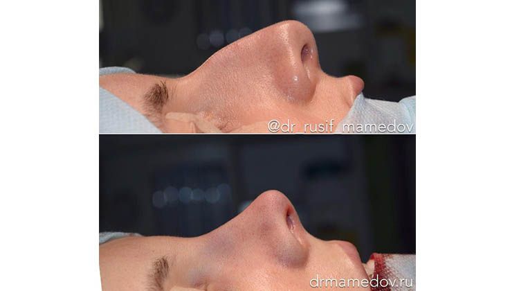 Динамичная скульптура носа с сохранением мягко-тканного покрытия, пластический хирург Мамедов Русиф Бежанович