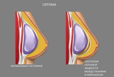 Что такое серома?