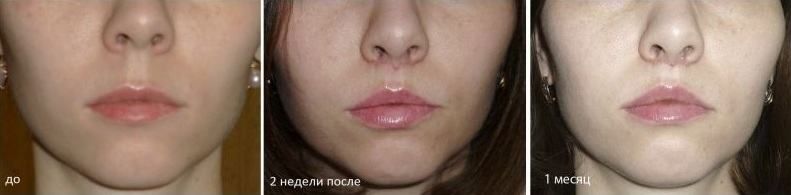 Контурная пластика — фото 8