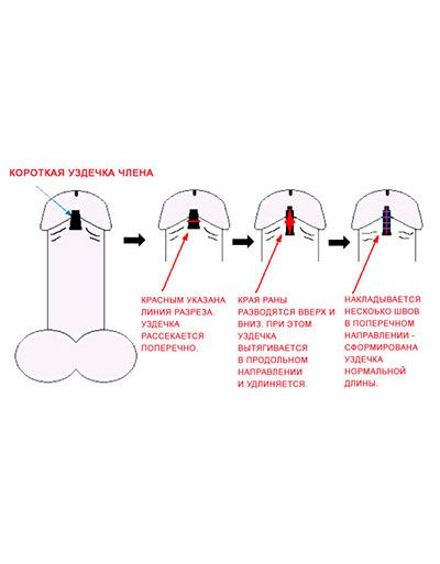 Френулотомия — пластика уздечки