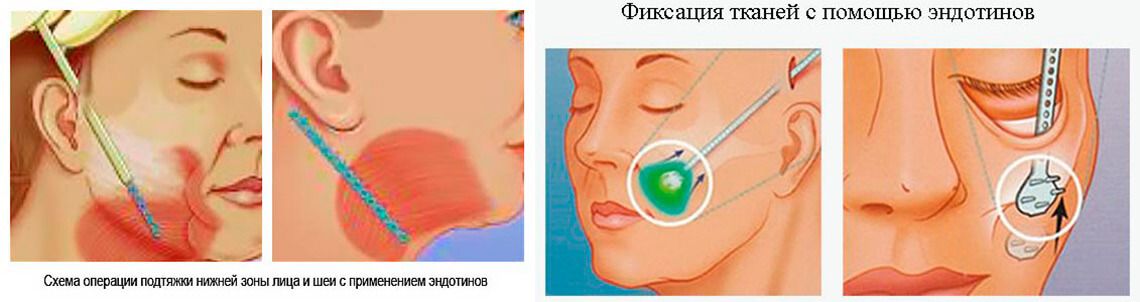 Как осуществляется подтяжка лица на эндотинах
