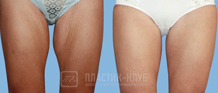 Феморопластика фото до и псоле