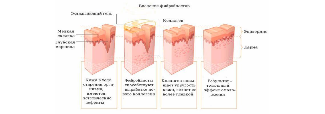 Введение фибробластов