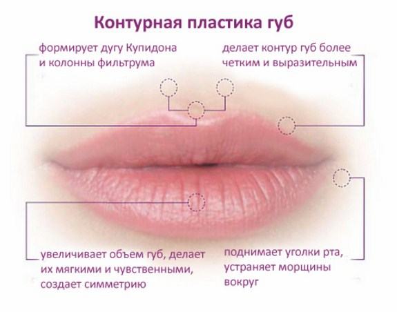 О&nbsp;процедуре контурной пластики губ