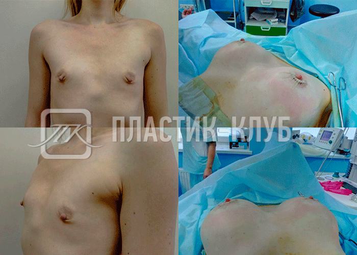 Результат коррекции соска и груди