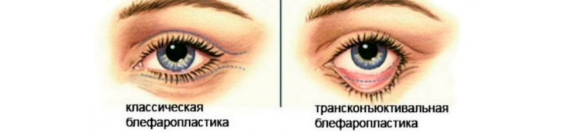 Виды блефаропластики нижних век