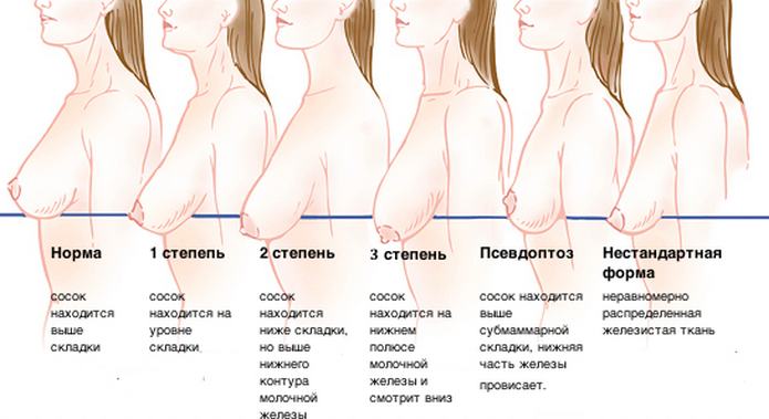 Степени птоза