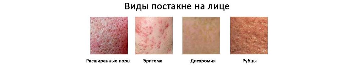 Виды постакне на лице