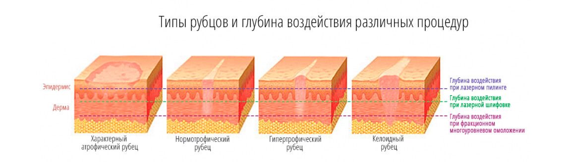 Типы рубцов и глубина воздействия различных процедур