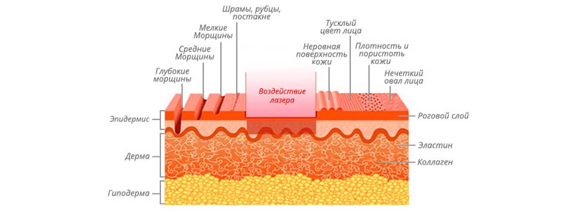 Лазерное воздействие на рубцы и шрамы