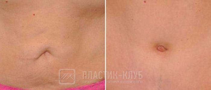 умбиликопластика фото до и после
