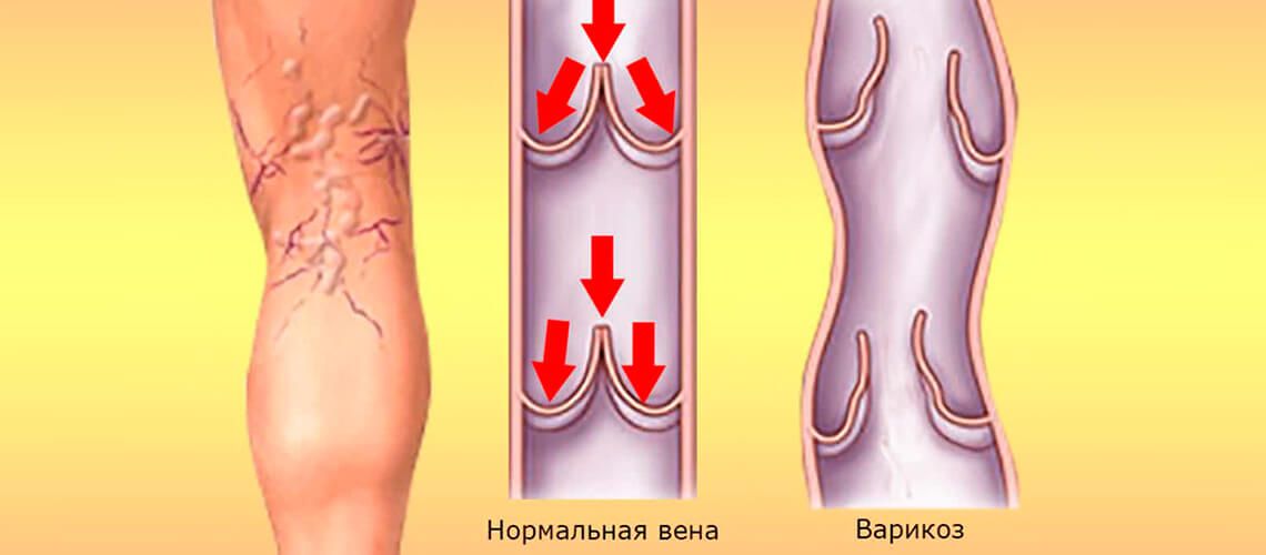 Нормальные вены и Варикоз вен