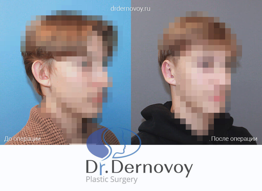 исправления ушной раковины