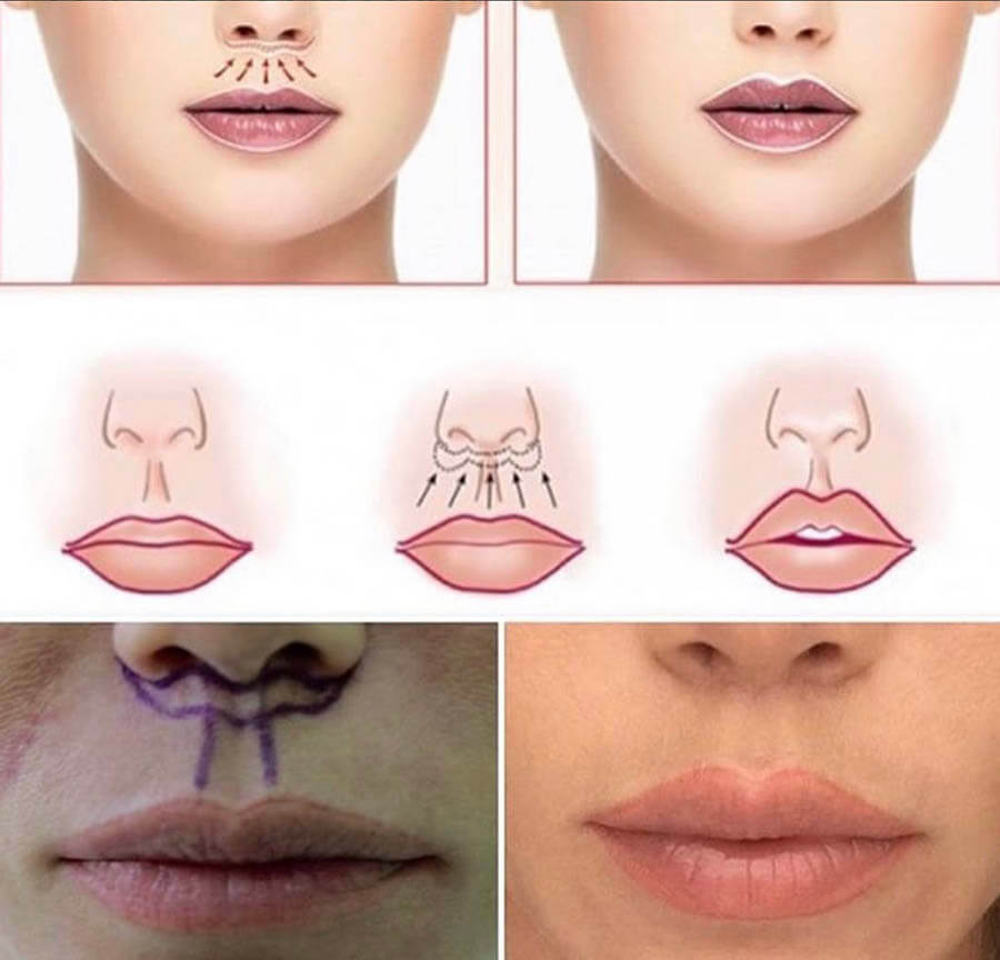 Булхорн фото до после увеличения губ