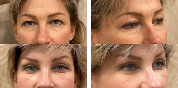 Почему ТОП-лифтинг — это ТОП?