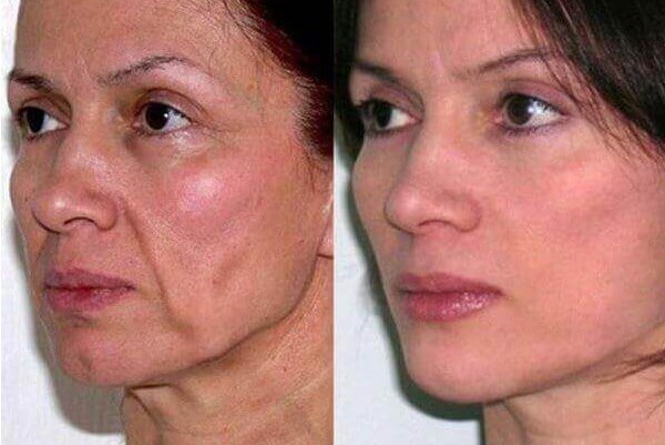 Фото до после СМАС-лифтинга