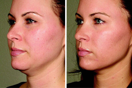 СМАС-лифтинг подбородка и нижней трети лица фото до после