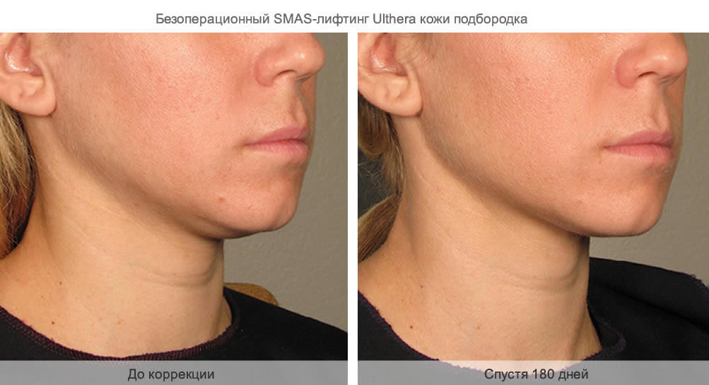 SMAS-лифтинг фото до после коррекции подбородка