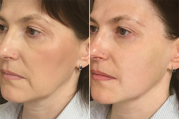 Фото до после СМАС-лифтинга