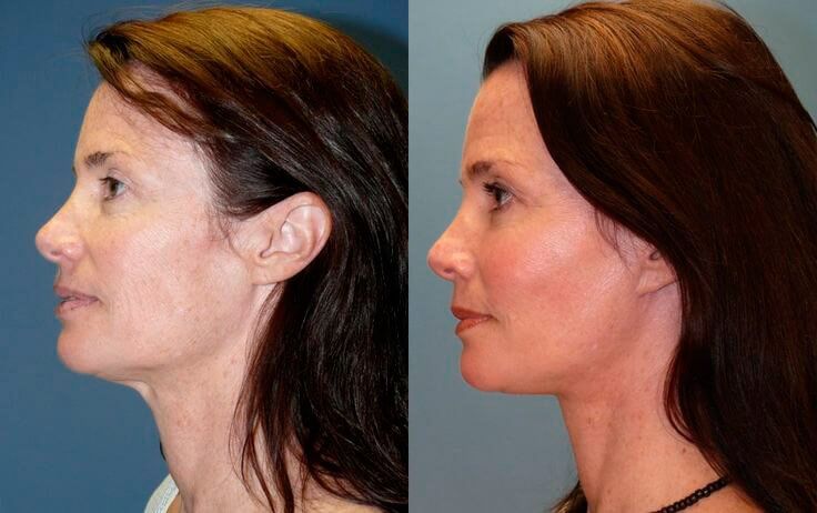 SMAS-лифтинг фото до после подтяжки лица и шеи