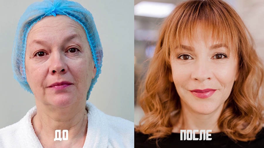 Комплексная операция SMAS-лифтинг фото до после