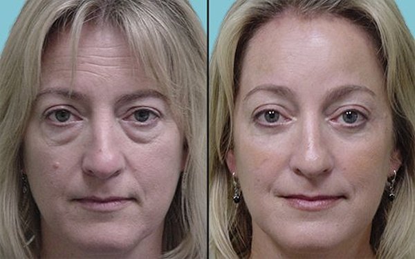 Фото до после блефаропластики для общего омоложения