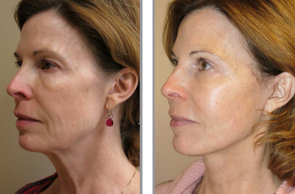 Фото до после круговой подтяжки лица