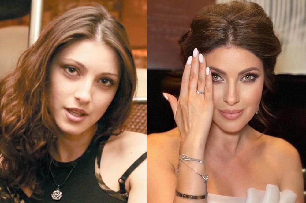 Анастасия Макеева пластика носа