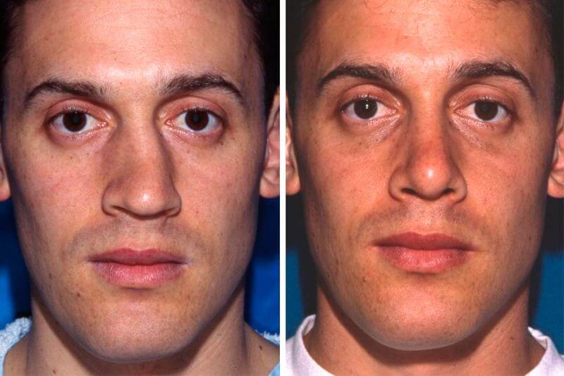 Частичное исправление асимметрии носа ринопластикой – фото до после