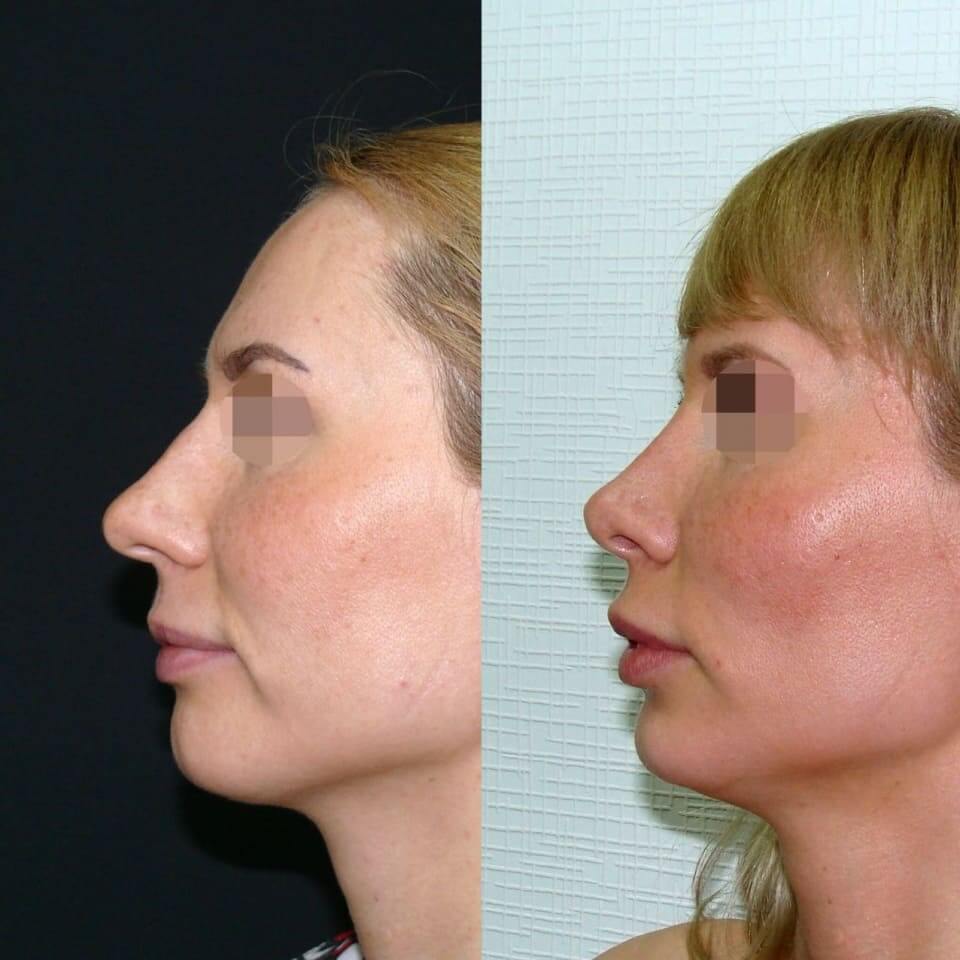Невидимая в профиль асимметрия носа фото до после пластики