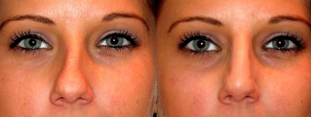 Асимметрия носа после ринопластики – коррекция асимметрии фото до после