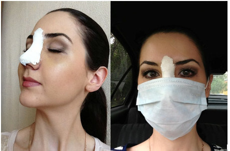 Асимметрия носа и ее коррекция ринопластикой