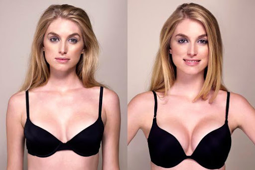 Фото до&nbsp;после увеличения маленькой груди