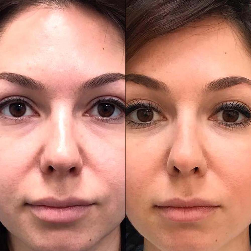 Фото до&nbsp;после липофилинга