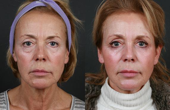 Липофилинг мешков под&nbsp;глазами