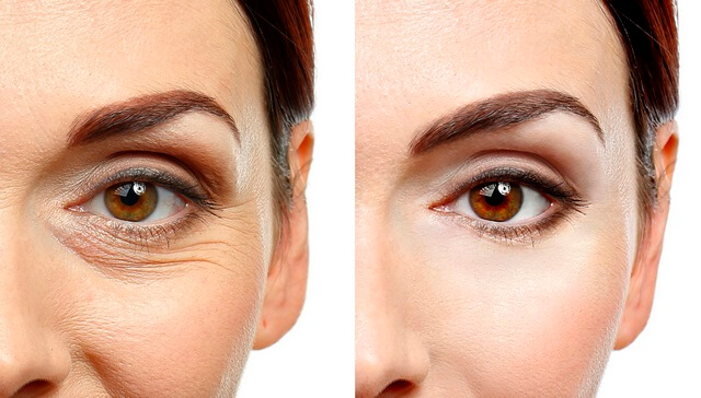 Фото до&nbsp;после блефаропластики