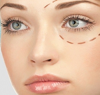 Безоперационная блефаропластика