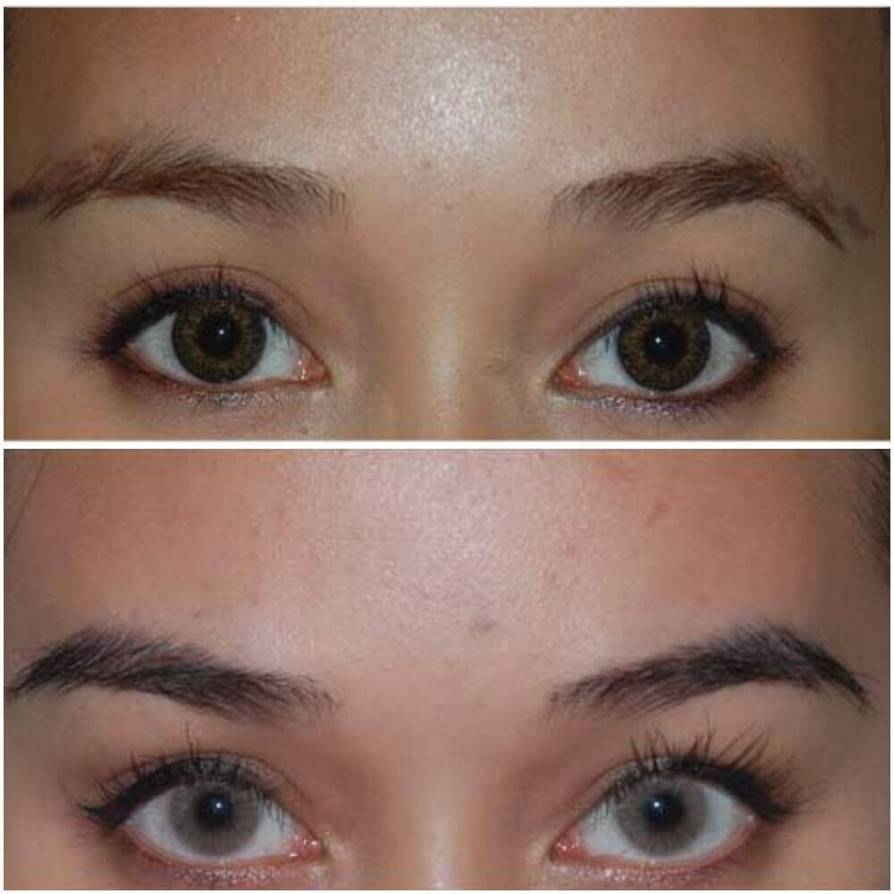 Фото до&nbsp;после пересадки бровей