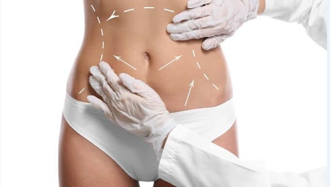 Липосакция или&nbsp;абдоминопластика, а&nbsp;что выбираете вы?