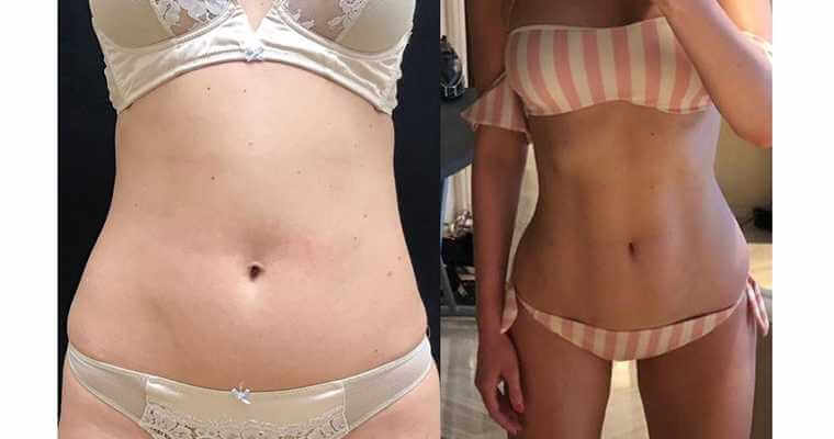 Фото до&nbsp;после абдоминопластики живота