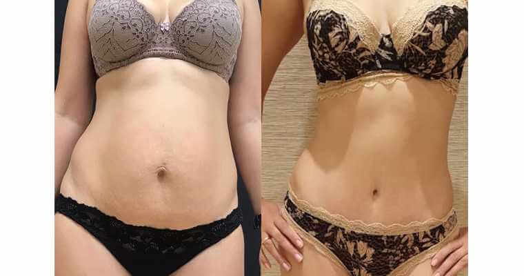 Абдоминопластика живота фото до&nbsp;после