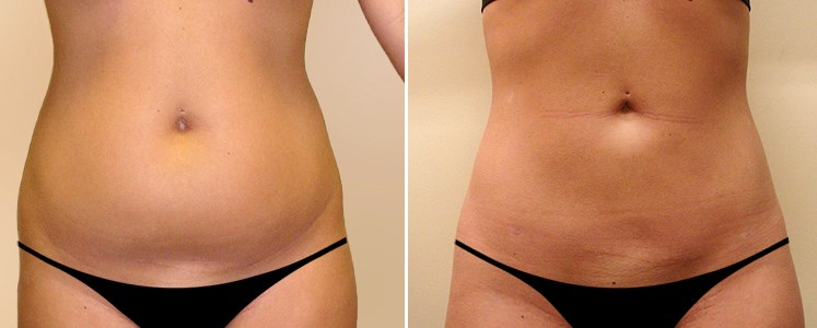Липосакция живота фото до&nbsp;после