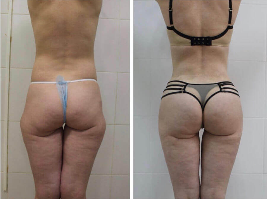 Липофилинг ягодиц фото до после