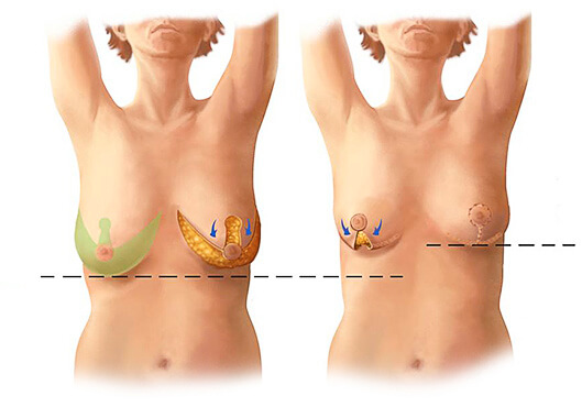 Принцип подтяжки груди