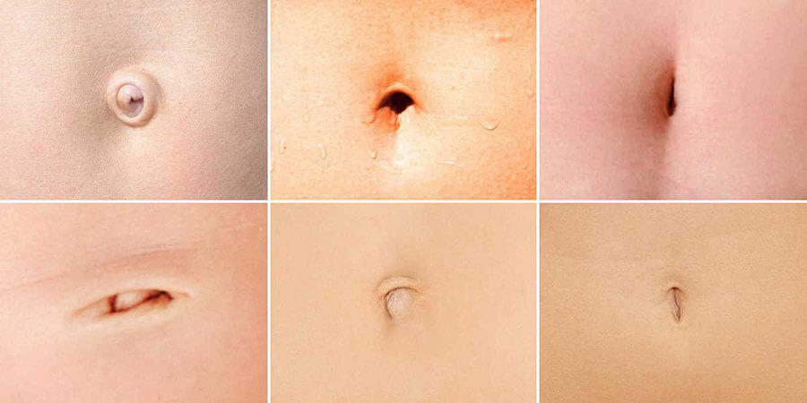 Вы сможете выбрать форму пупка после абдоминопластики