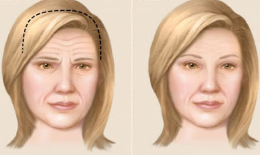 Когда нужна подтяжка висков и бровей?