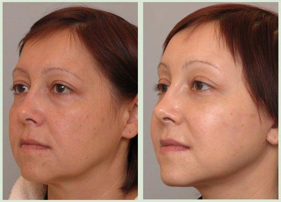 Темпоропластика фото до после операции