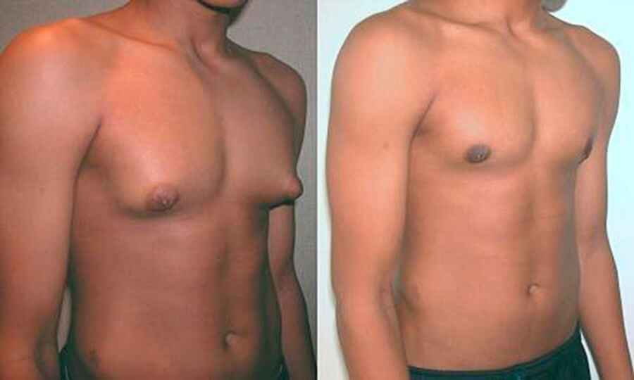 Фото до после коррекции тубулярной груди у мужчин